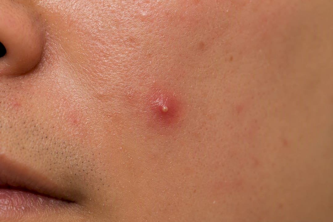 Close-up of inflamed pimple folliculitis on skin