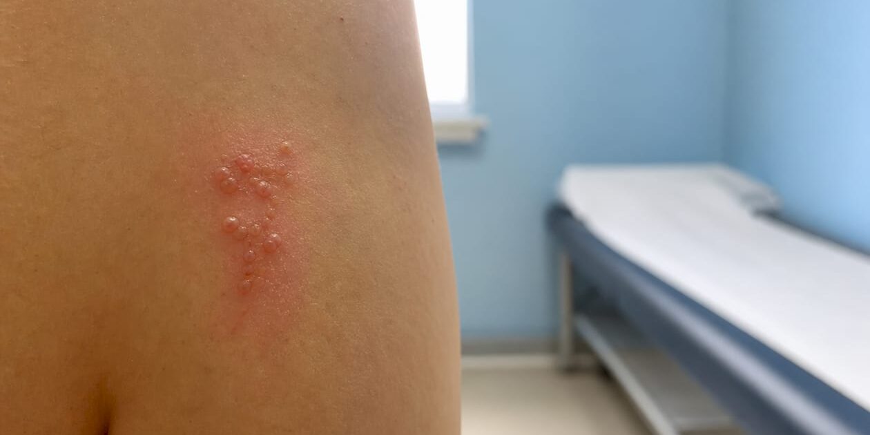 1786970296686_Clustered-herpes-blisters-on-skin-close-up Clustered herpes blisters on skin close-up