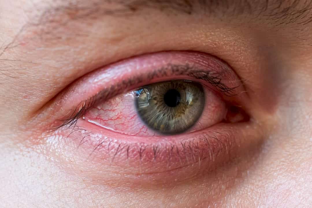 Close-up of red irritated eye